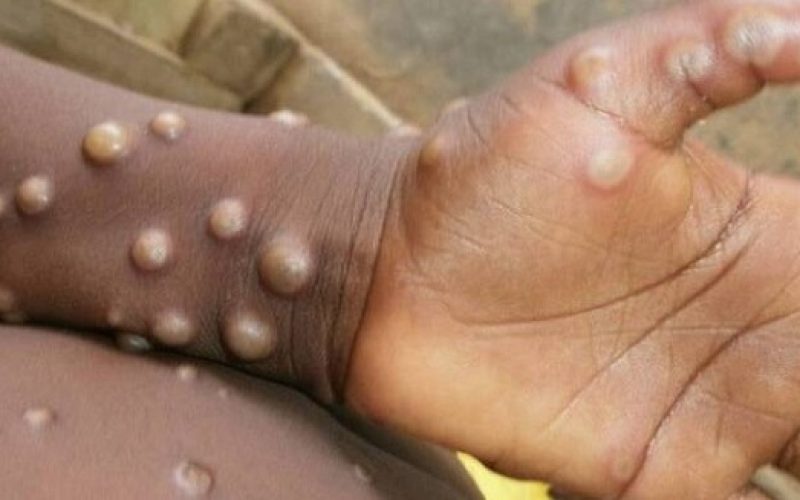Terceiro caso de Monkeypox é confirmado no Amazonas