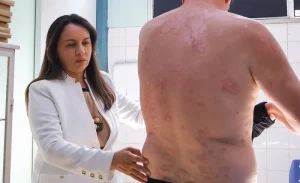 Dia Mundial Da Psoríase  Ses Am Destaca Importância Do Diagnóstico E Tratamento Contínuo