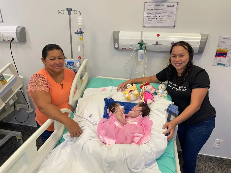 Gêmeas Siamesas Do Amazonas Recebem Alta Da Uti Após Cirurgia Complexa De Separação